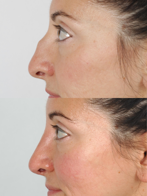 Rinoplastia antes y después