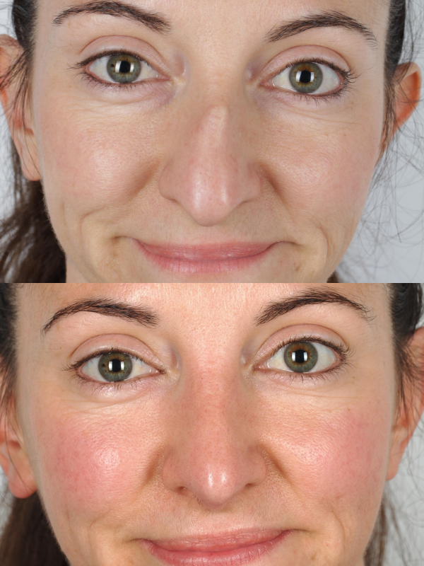 Rinoplastia antes y después