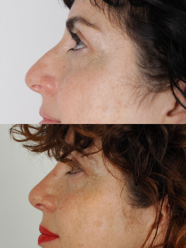 Rinoplastia antes y después