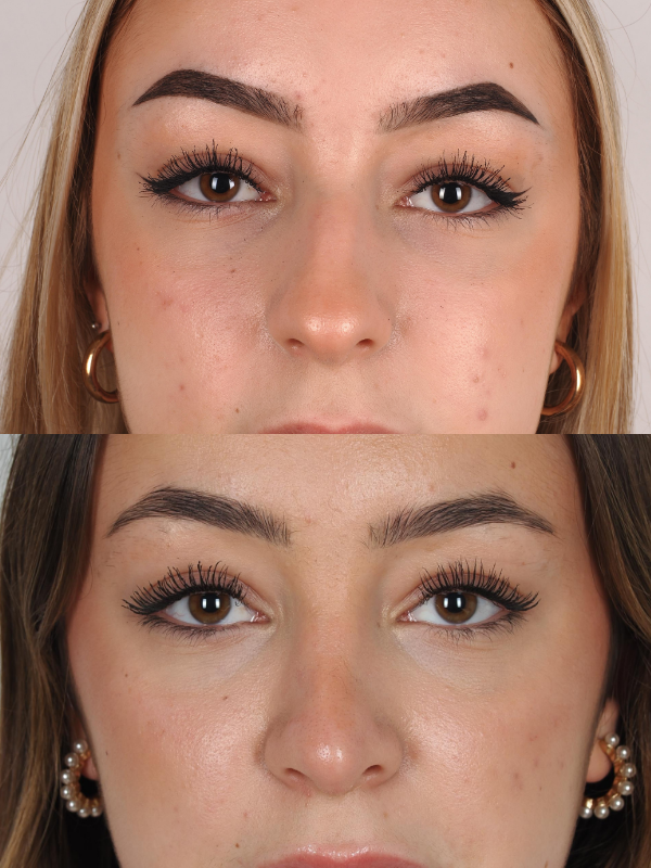 Rinoplastia antes y después