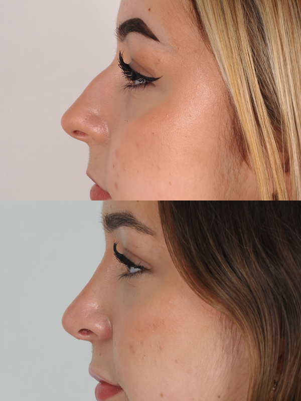 Rinoplastia antes y después