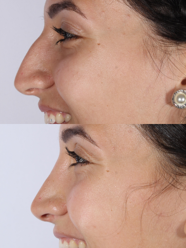 Rinoplastia antes y después