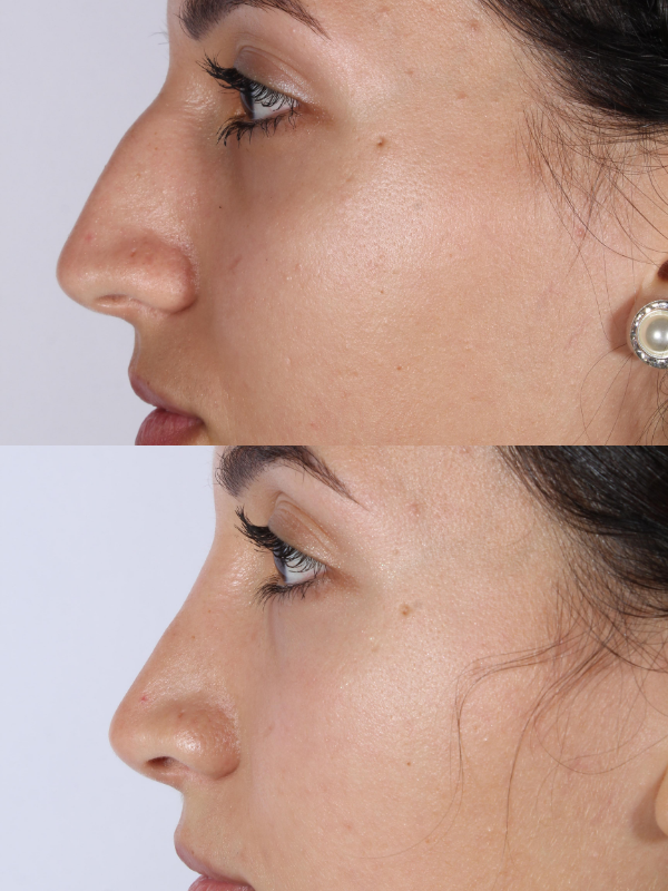 Rinoplastia antes y después