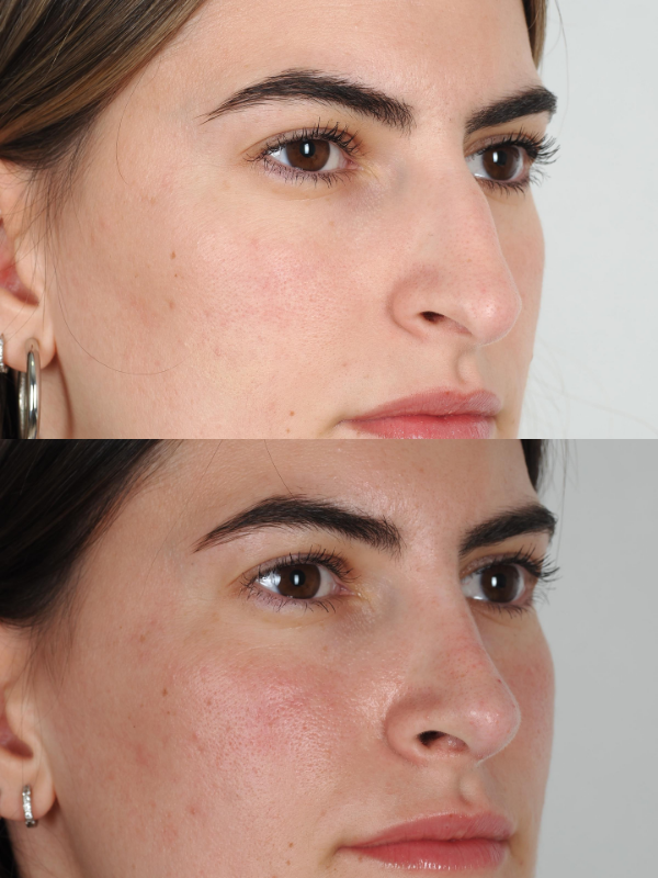 Rinoplastia Ultrasónica antes y después