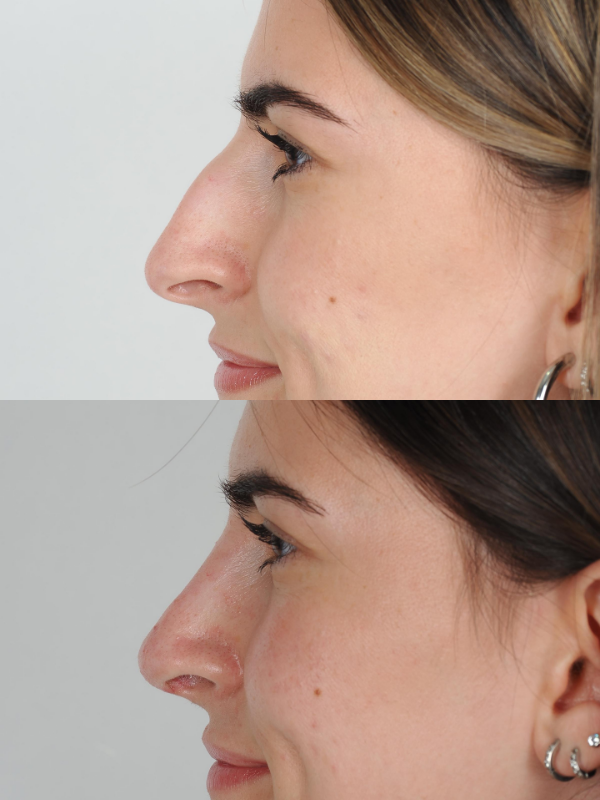 Rinoplastia Ultrasónica antes y después