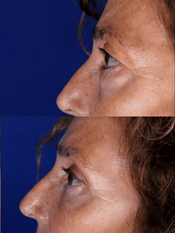 Blefaroplastia antes y después