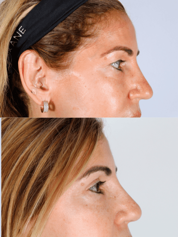 Blefaroplastia antes y después