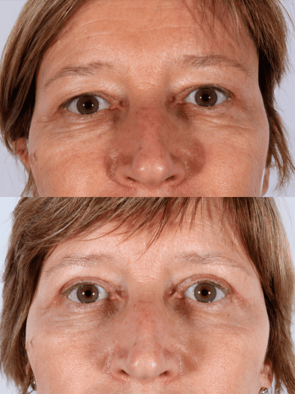 Blefaroplastia antes y después