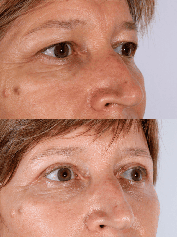 Blefaroplastia antes y después