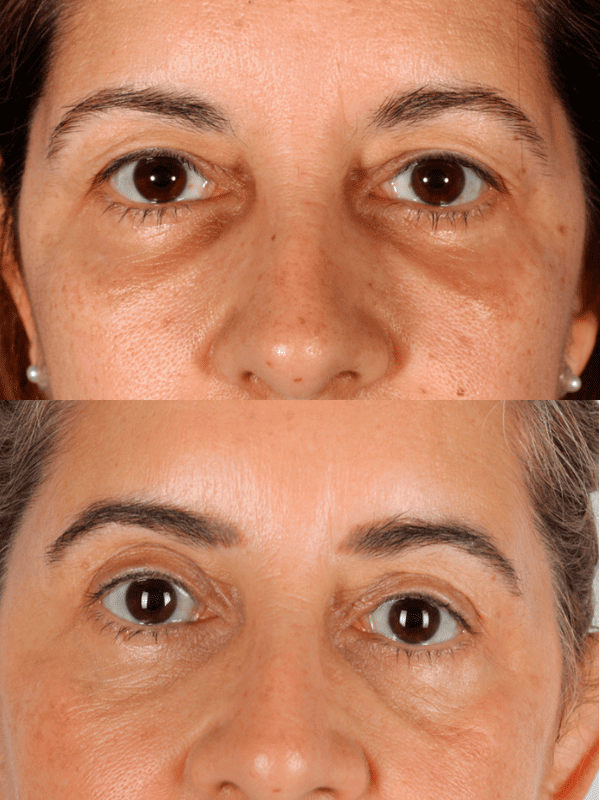 Blefaroplastia antes y después