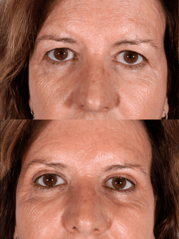 Blefaroplastia antes y después