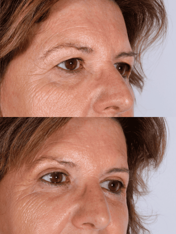 Blefaroplastia antes y después