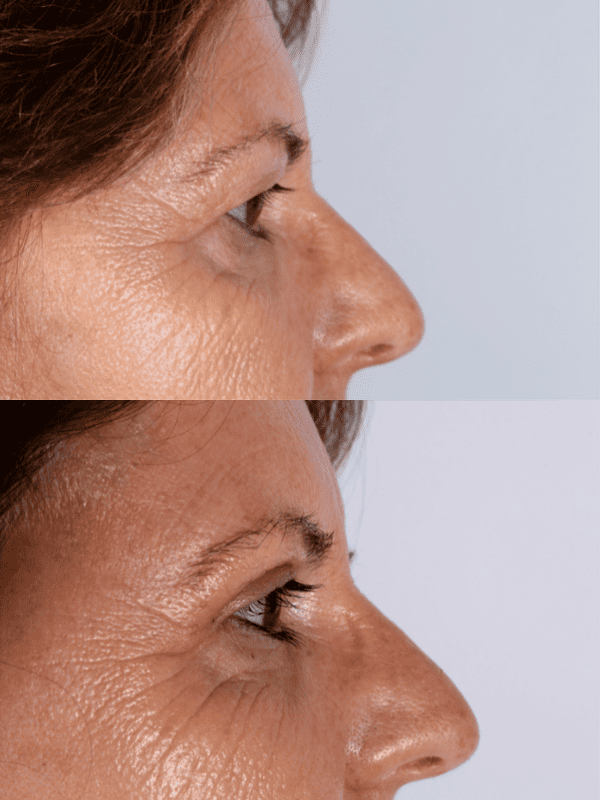 Blefaroplastia antes y después
