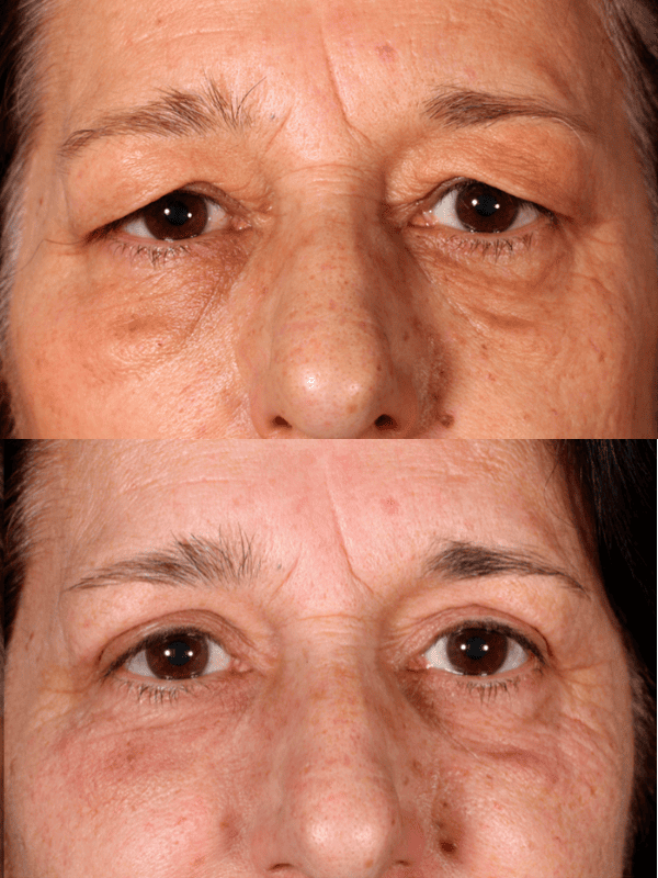 Blefaroplastia antes y después