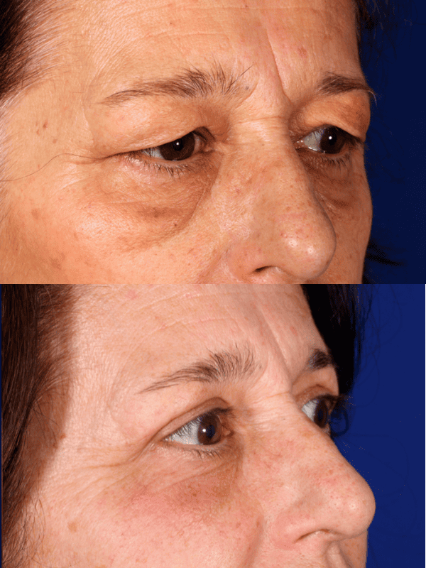 Blefaroplastia antes y después
