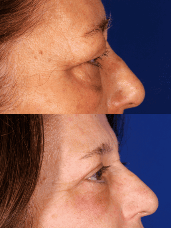 Blefaroplastia antes y después