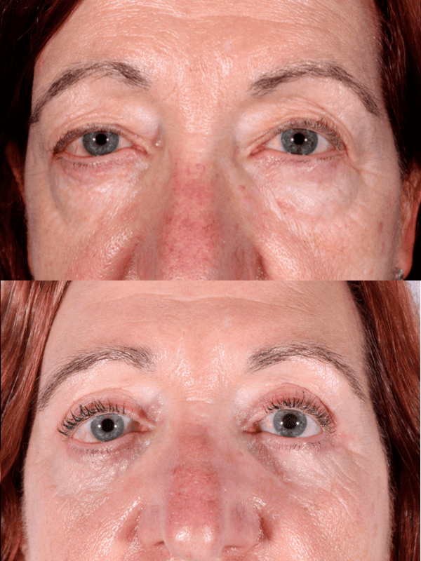 Blefaroplastia antes y después