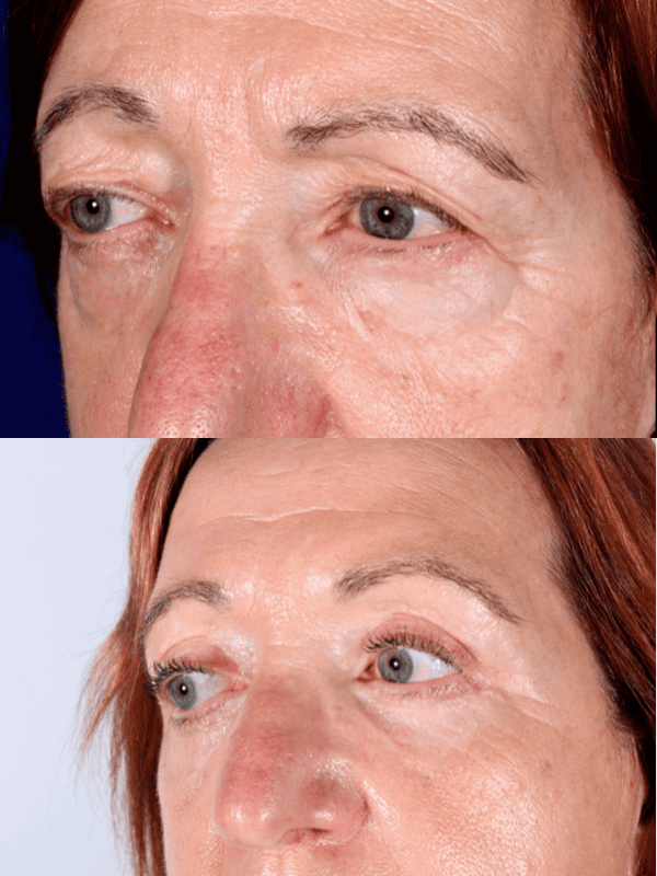 Blefaroplastia antes y después