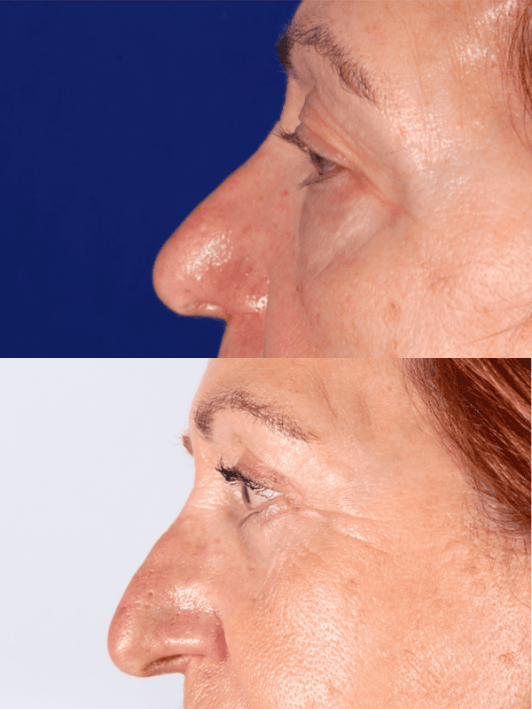 Blefaroplastia antes y después