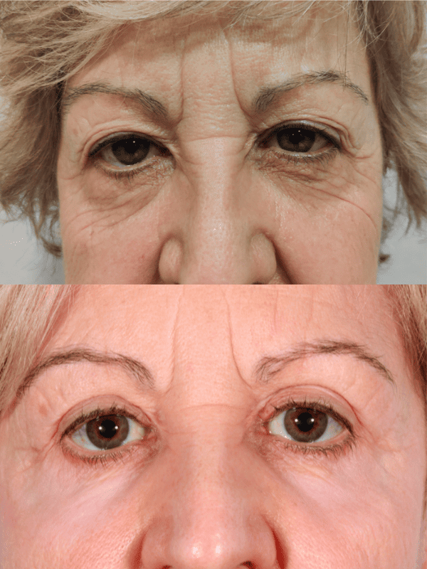 Blefaroplastia antes y después