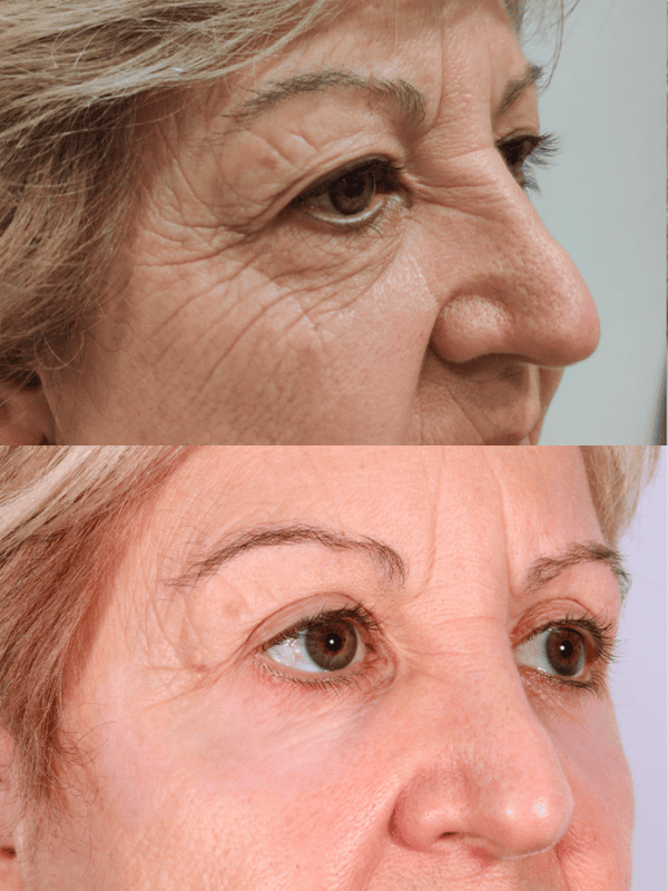 Blefaroplastia antes y después