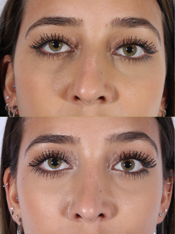 Rinoplastia antes y después