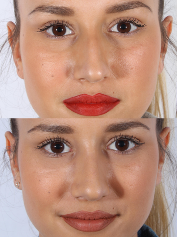 Rinoplastia antes y después