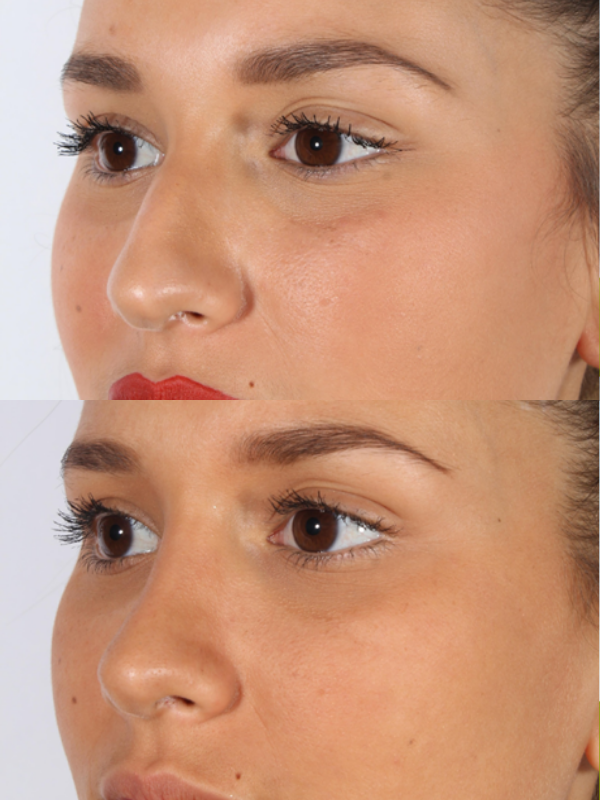 Rinoplastia antes y después