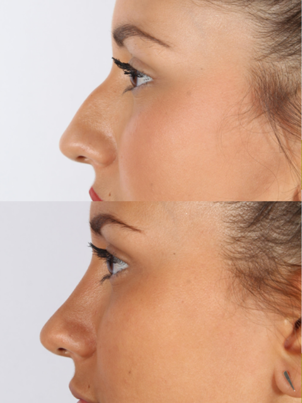 Rinoplastia antes y después