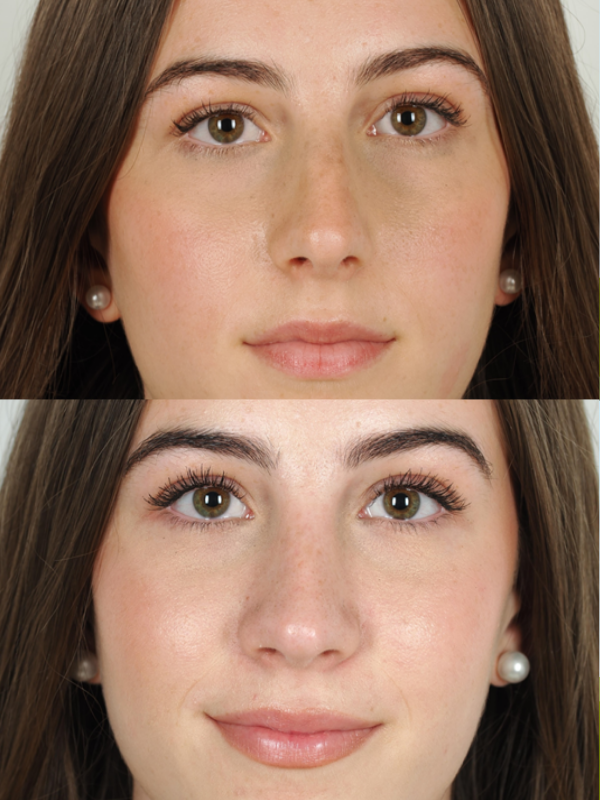 Rinoplastia antes y después