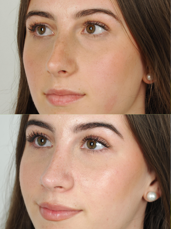 Rinoplastia antes y después