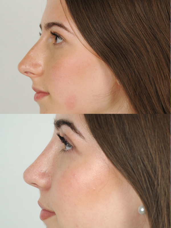 Rinoplastia antes y después