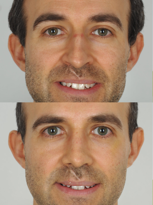 Rinoplastia antes y después