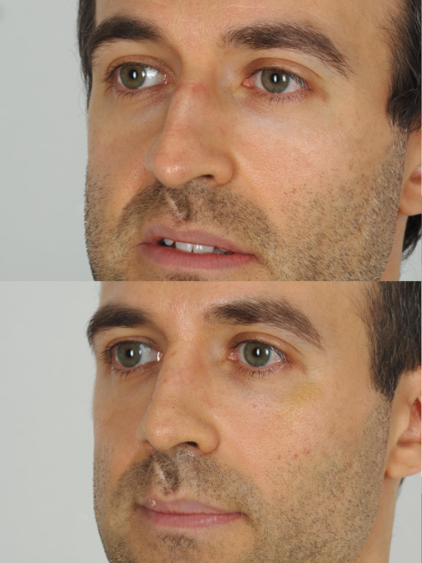 Rinoplastia antes y después