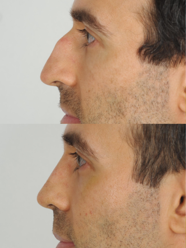 Rinoplastia antes y después