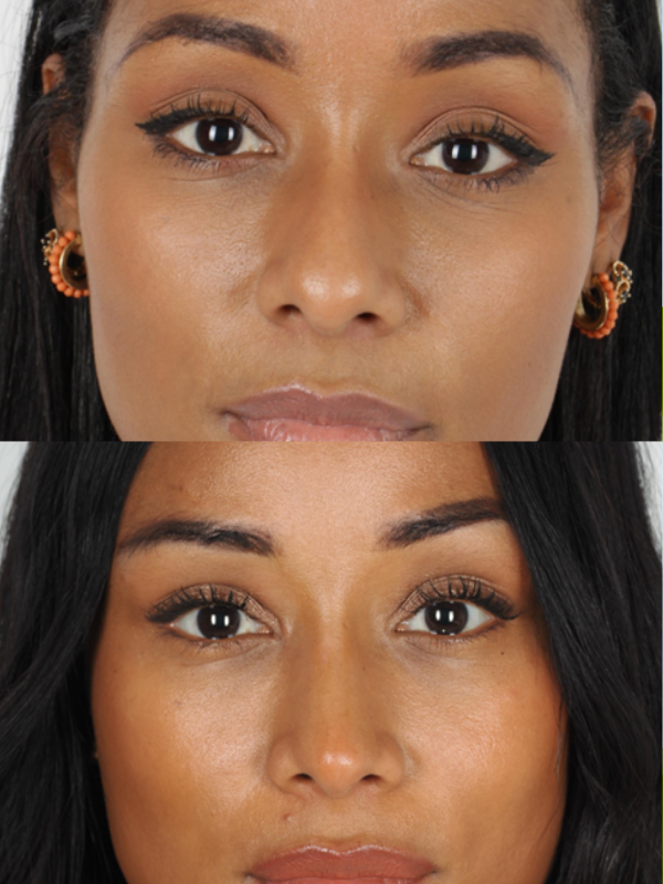 Rinoplastia antes y después