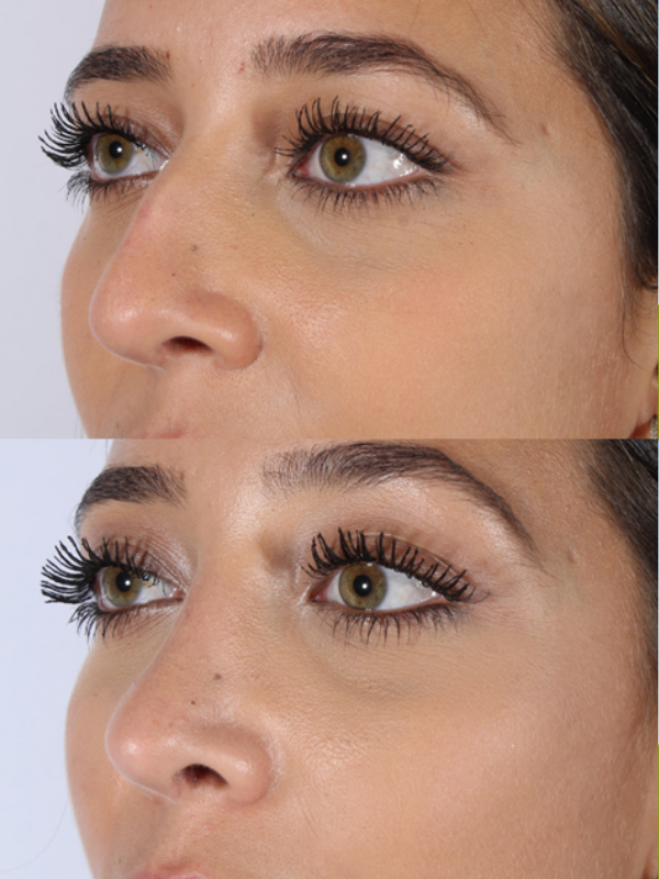 Rinoplastia antes y después