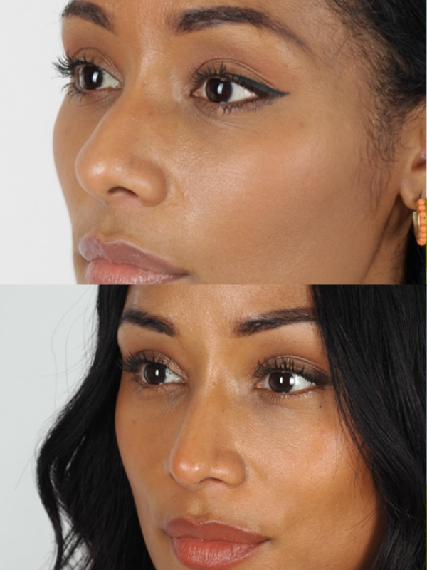 Rinoplastia antes y después