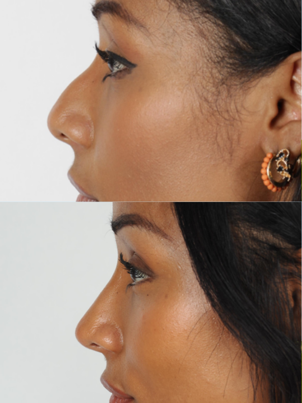 Rinoplastia antes y después