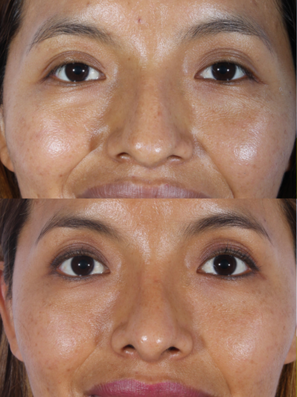 Rinoplastia antes y después