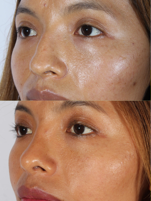 Rinoplastia antes y después