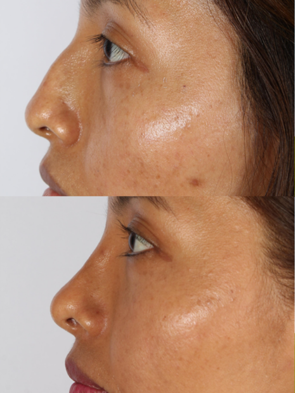 Rinoplastia antes y después