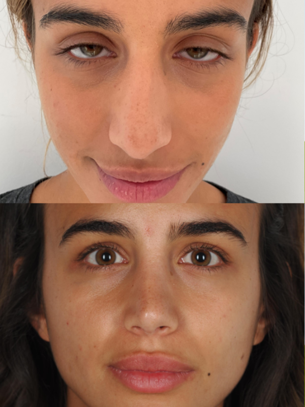 Rinoplastia antes y después