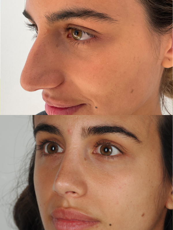 Rinoplastia antes y después