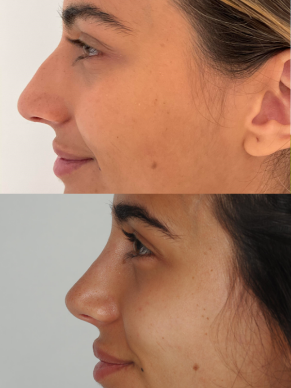 Rinoplastia antes y después