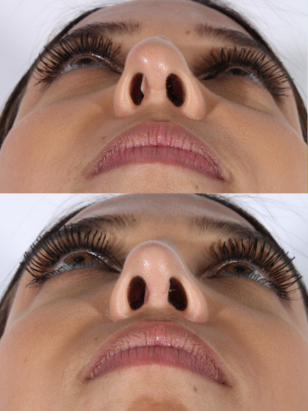 Rinoplastia antes y después
