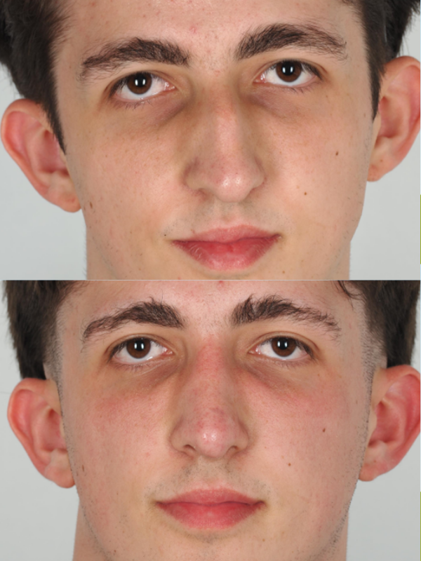 Rinoplastia antes y después