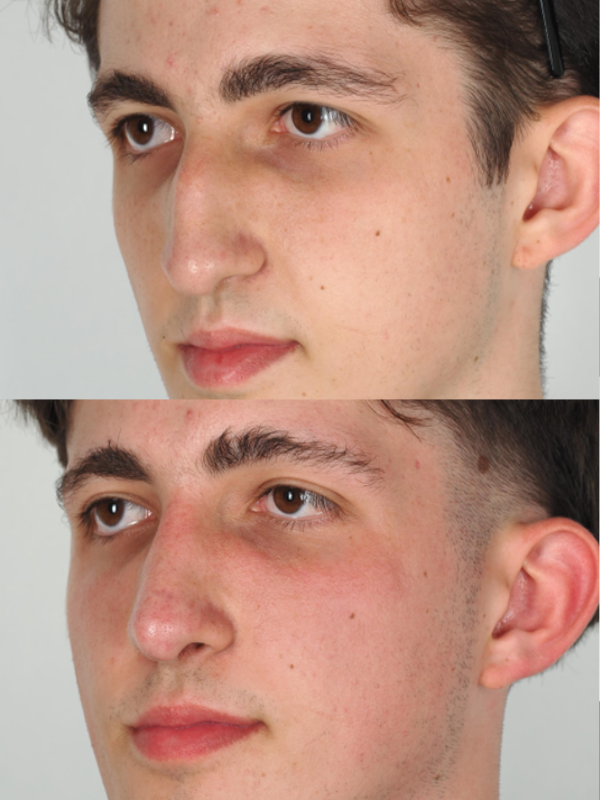 Rinoplastia antes y después
