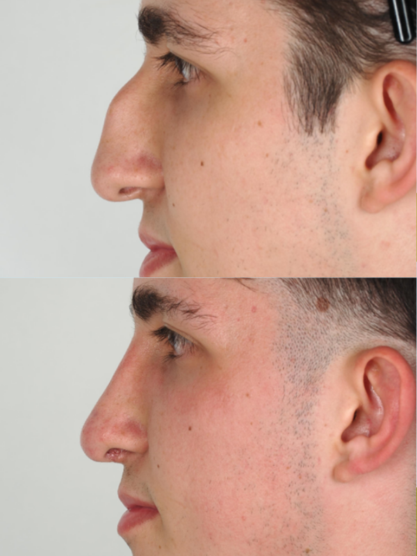 Rinoplastia antes y después