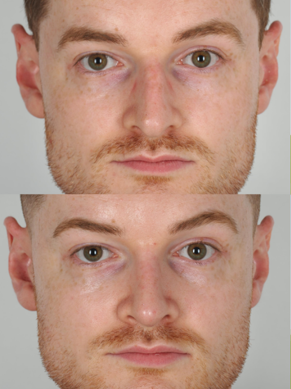 Rinoplastia Ultrasónica antes y después